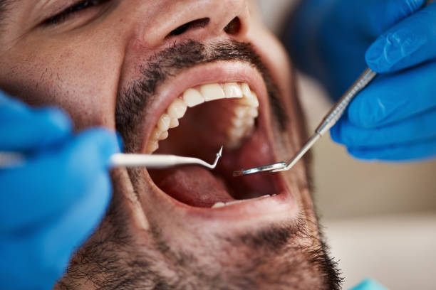 Best Knocked-Out Tooth (Avulsed Tooth) Treatment in Bradford, OH