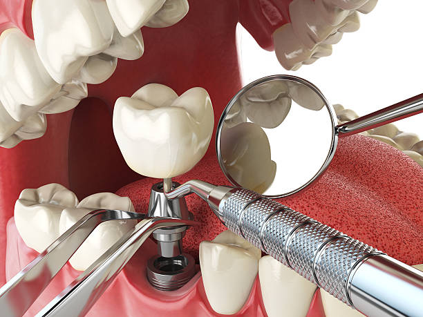 Best Dental Abscess Treatment in Bradford, OH